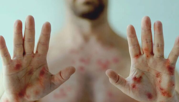 جدري القرود