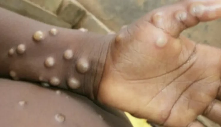 إعلان جدري القردة حالة طوارئ صحية عالمية