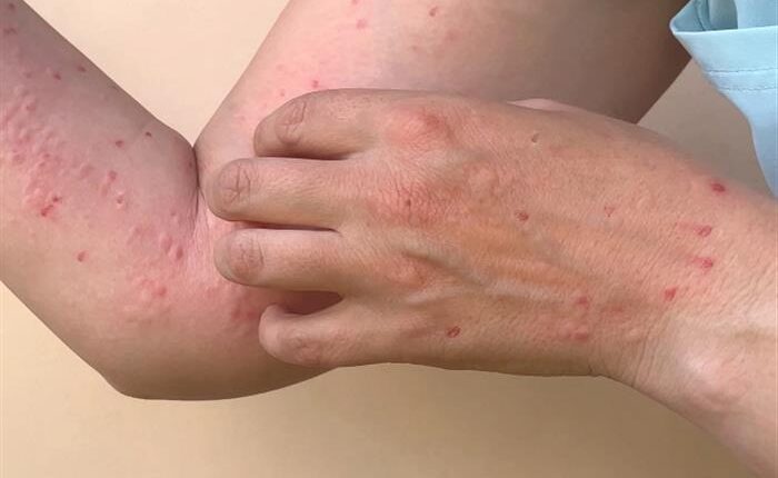 لا يمكن اعتبار جدري القردة وباء “كوفيد جديد”